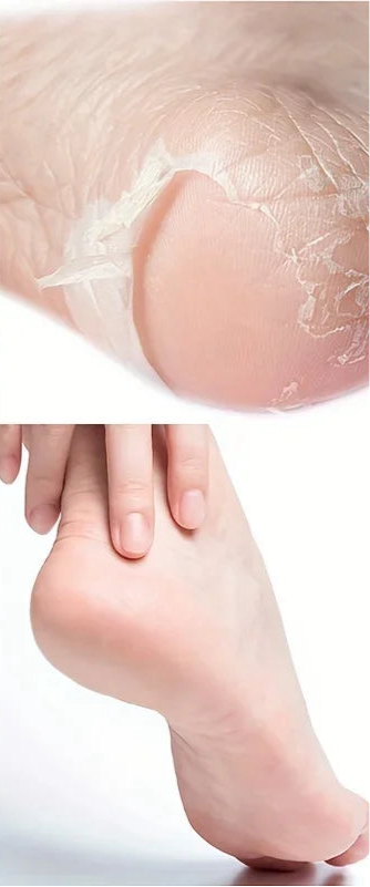 SILKSOLE – Luxury Foot Peel Mask